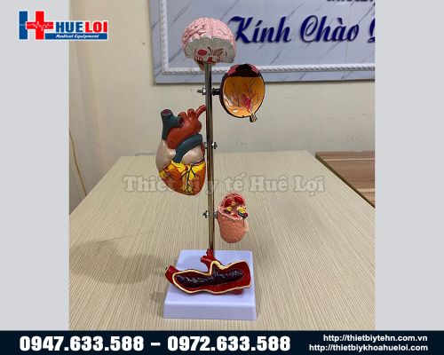 Mô hình biến chứng của bệnh tăng huyết áp