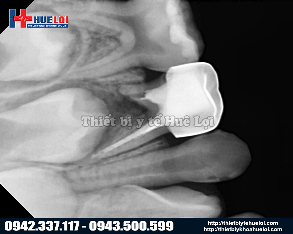 chất lượng hình ảnh xquang răng