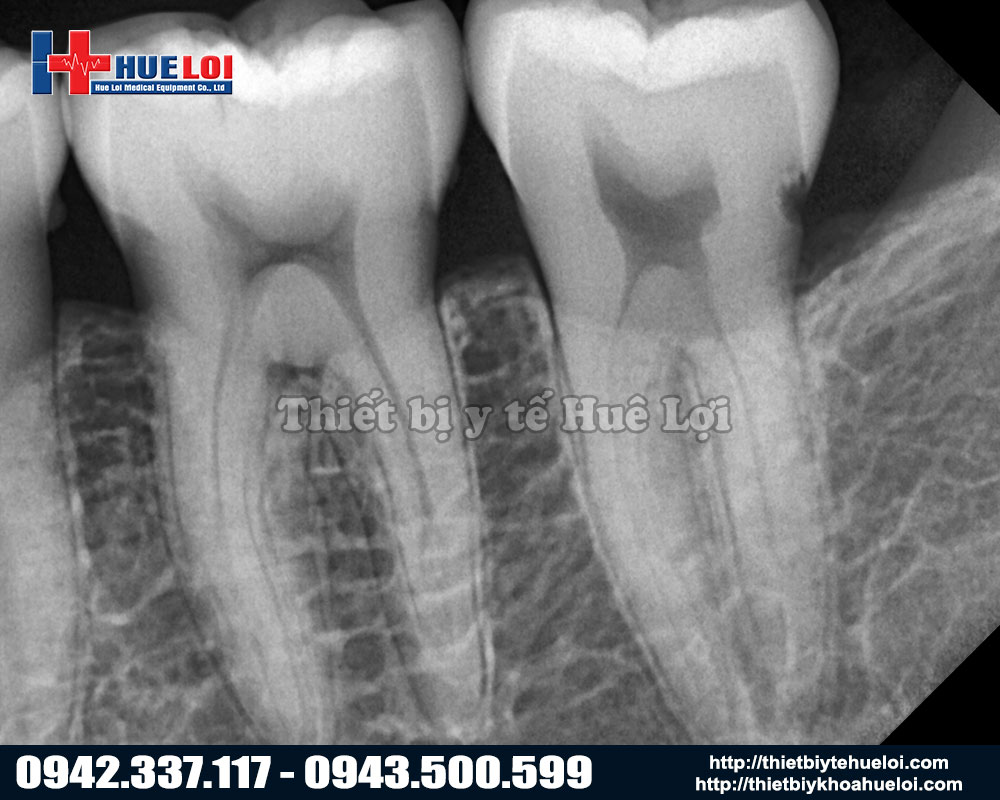 chất lượng hình ảnh xquang nha khoa