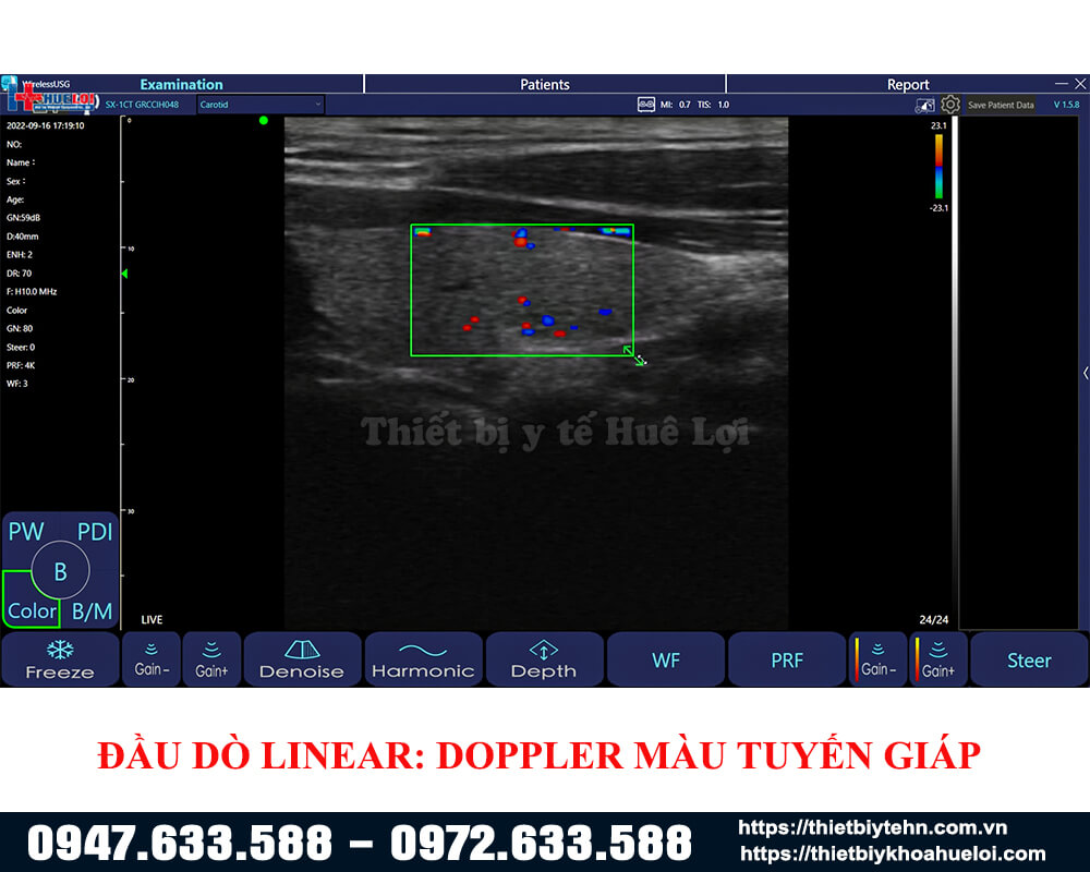 doppler tuyến giáp