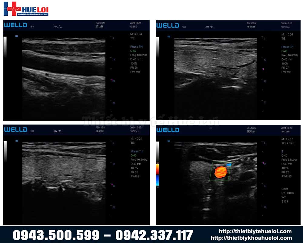 chất lượng hình ảnh máy siêu âm xách tay p10