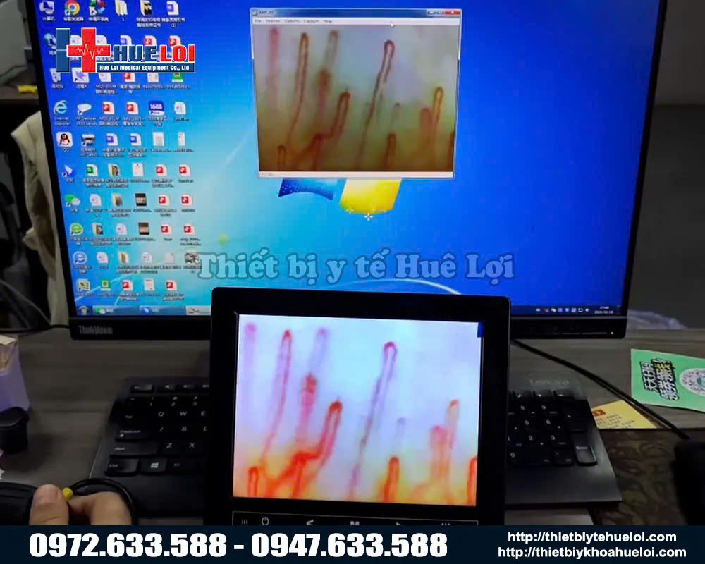 kết quả hình ảnh từ kết nối máy tính của kính soi mạch máu