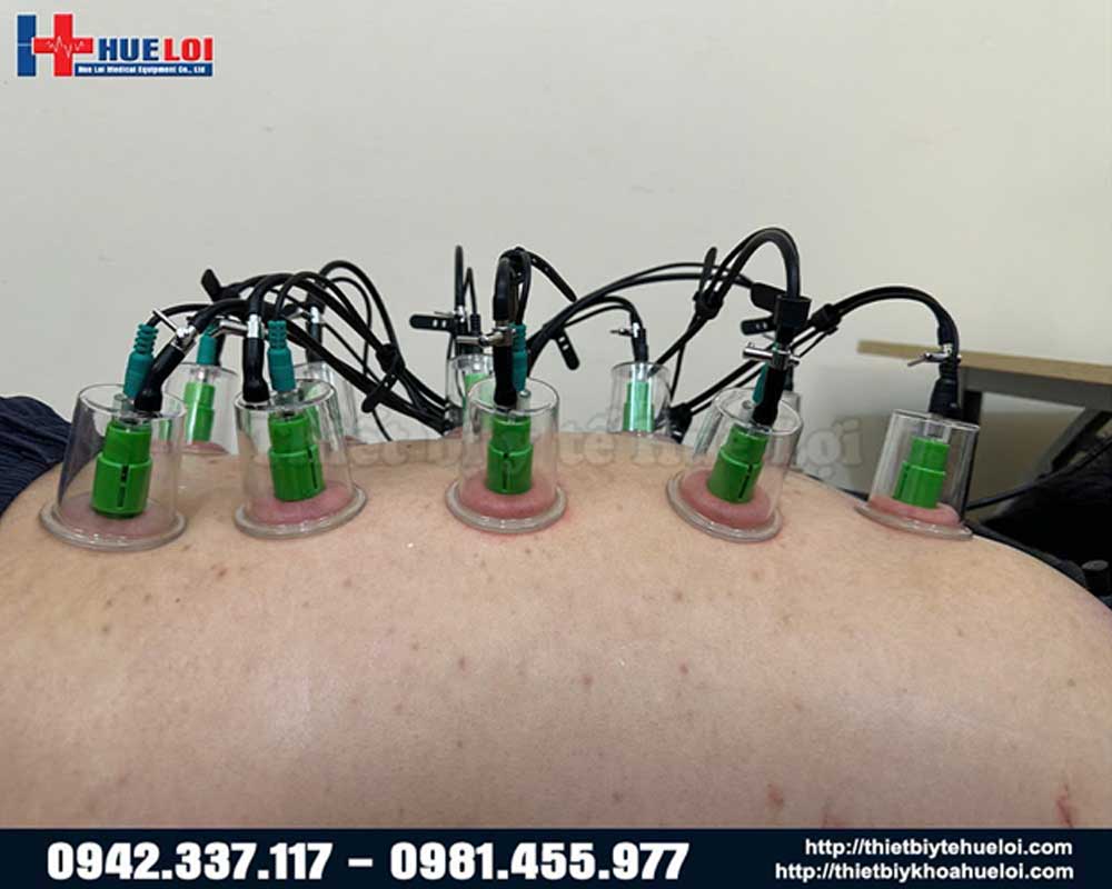cốc điện châm giác hút máy điện châm không xâm lấn