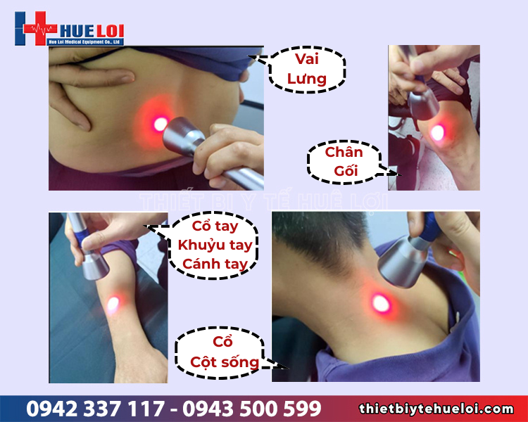 điều trị bằng sóng laser