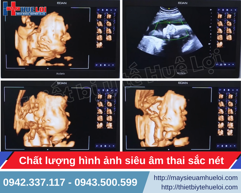 siêu âm thai nhi