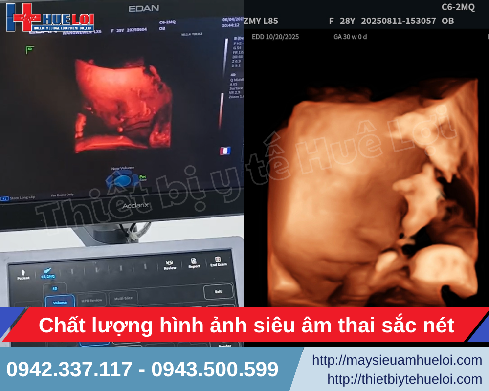 hình ảnh siêu âm thai nhi