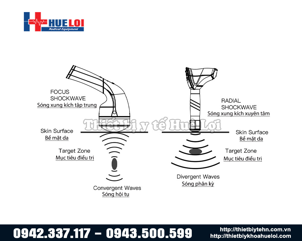 Nguyên lý 2 loại sóng xung kích trị liệu 