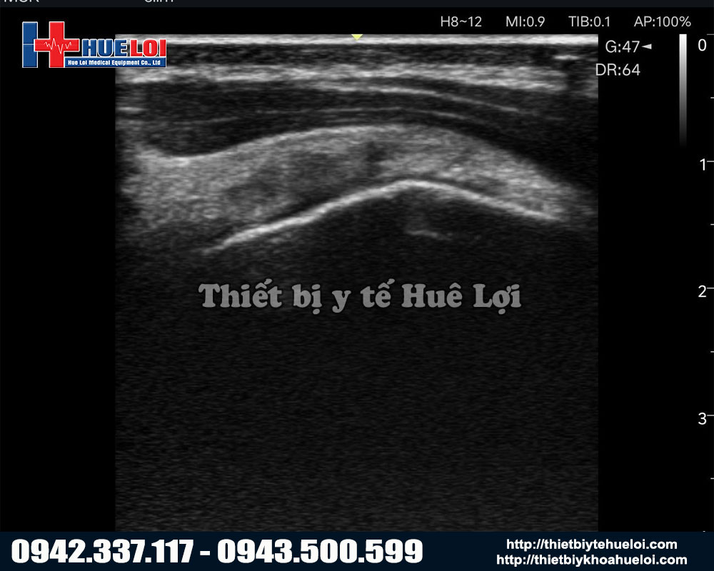 Chất lượng hình ảnh máy siêu âm