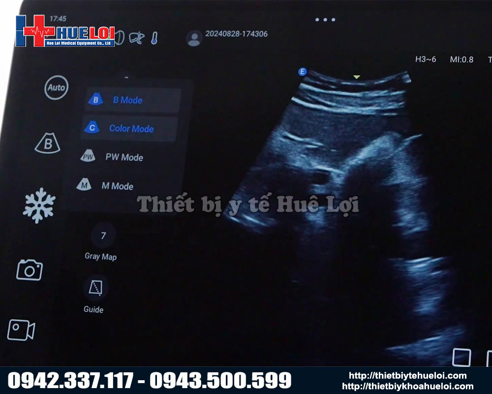 chất lượng hình ảnh siêu âm
