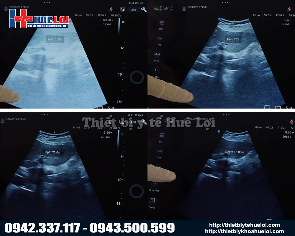 chất lượng hình ảnh siêu âm