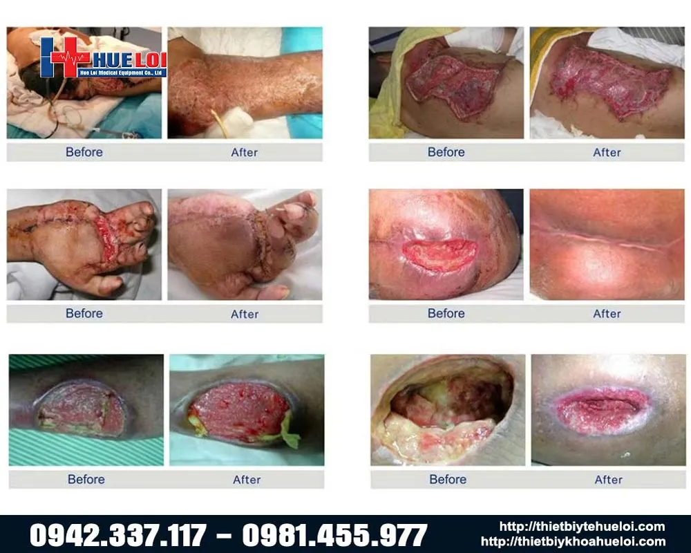 các loại vết thương trước sau sử dụng máy làm lành vết thương bằng ánh sáng