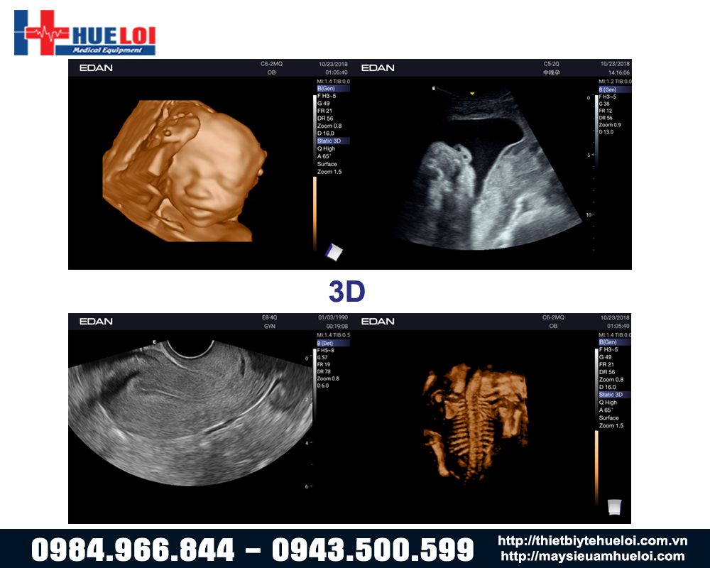 chất lượng hình ảnh 3d của máy siêu âm ax3