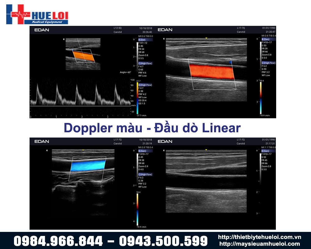 chế độ doppler màu của máy siêu âm ax3