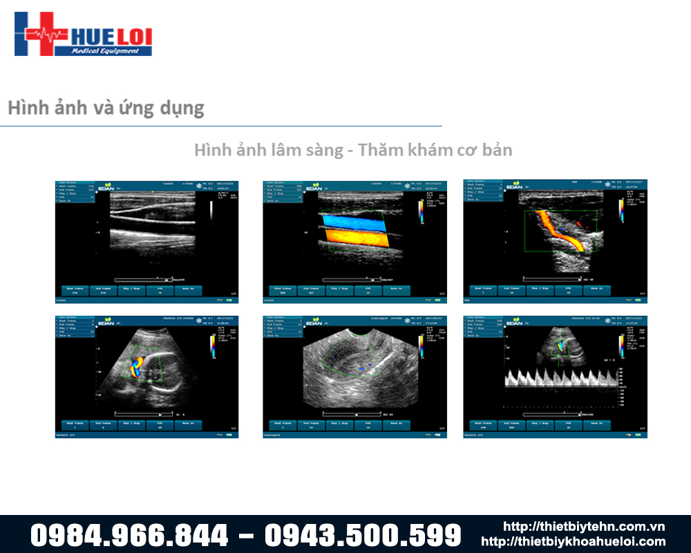 hình ảnh lâm sàng máy siêu âm edan u60