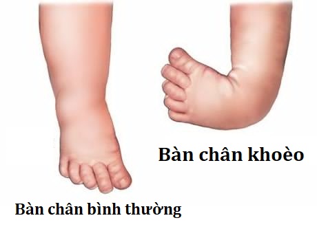 hình ảnh bị tật bàn chân