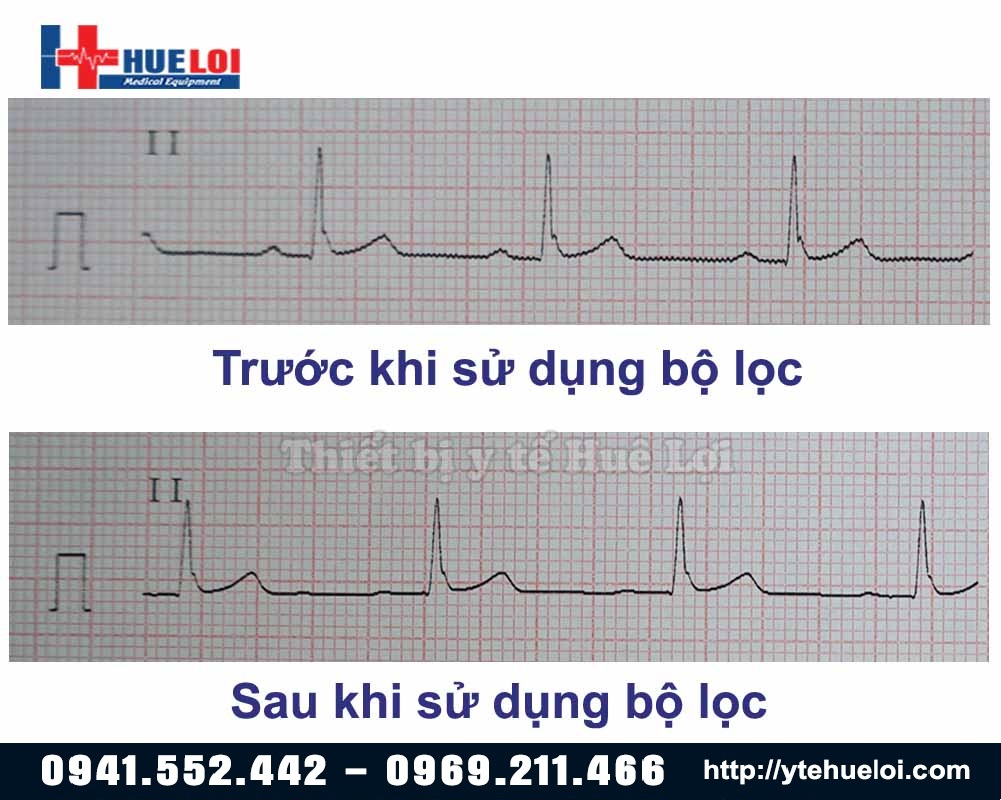 tác dụng của bộ lọc trong máy điện tim 6 kênh contec