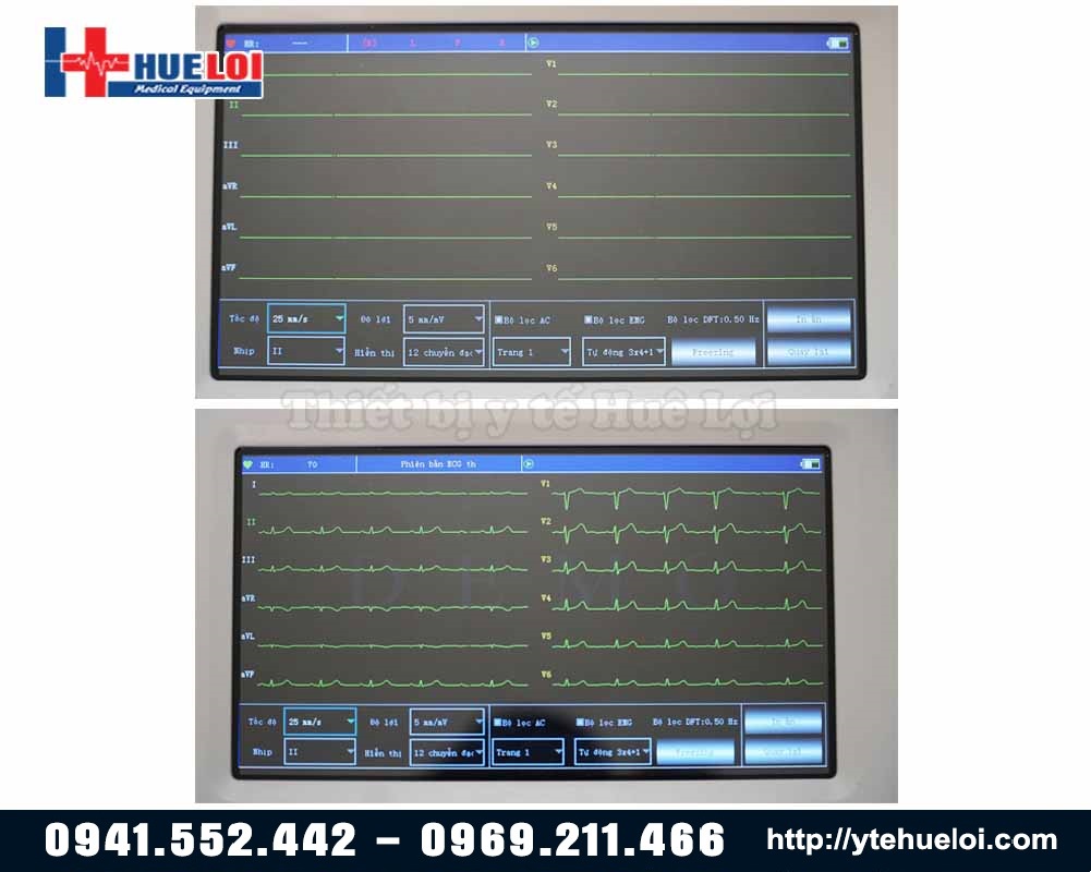 Màn hình kết quả đo của máy điện tim 6 kênh